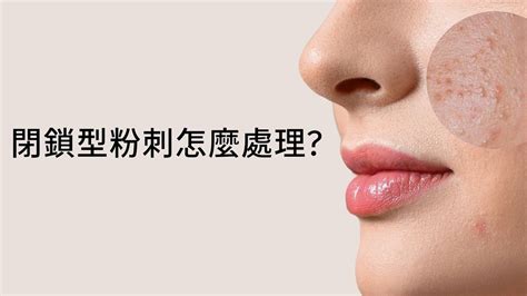 蘭若仙施|[心得] 關於閉鎖性粉刺